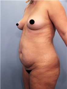 Tummy Tuck Before Photo by Marvin Shienbaum, MD; Brandon, FL - Case 44708