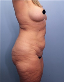 Tummy Tuck Before Photo by Marvin Shienbaum, MD; Brandon, FL - Case 44710