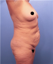 Tummy Tuck Before Photo by Marvin Shienbaum, MD; Brandon, FL - Case 44712