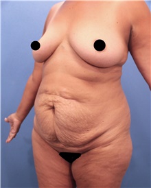 Tummy Tuck Before Photo by Marvin Shienbaum, MD; Brandon, FL - Case 44712