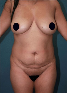 Tummy Tuck Before Photo by Marvin Shienbaum, MD; Brandon, FL - Case 44737