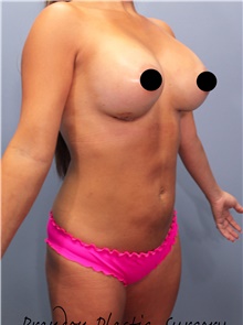 Breast Augmentation After Photo by Marvin Shienbaum, MD; Brandon, FL - Case 44738