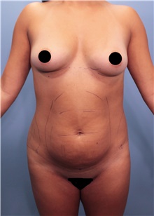 Breast Augmentation Before Photo by Marvin Shienbaum, MD; Brandon, FL - Case 44738