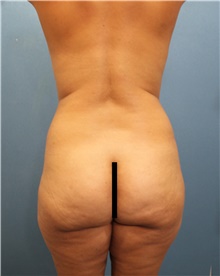 Tummy Tuck Before Photo by Marvin Shienbaum, MD; Brandon, FL - Case 44747