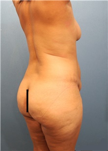 Tummy Tuck Before Photo by Marvin Shienbaum, MD; Brandon, FL - Case 44747