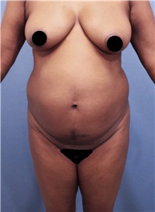 Tummy Tuck Before Photo by Marvin Shienbaum, MD; Brandon, FL - Case 44748