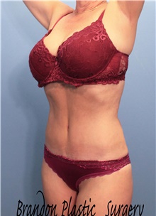 Tummy Tuck After Photo by Marvin Shienbaum, MD; Brandon, FL - Case 44749