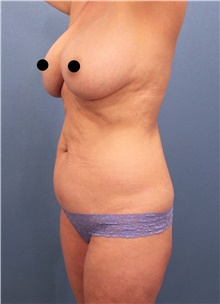 Tummy Tuck Before Photo by Marvin Shienbaum, MD; Brandon, FL - Case 44749