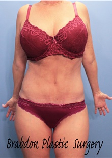 Tummy Tuck After Photo by Marvin Shienbaum, MD; Brandon, FL - Case 44749