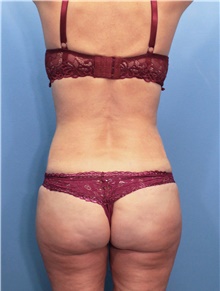 Tummy Tuck After Photo by Marvin Shienbaum, MD; Brandon, FL - Case 44749