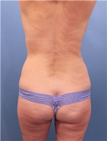 Tummy Tuck Before Photo by Marvin Shienbaum, MD; Brandon, FL - Case 44749