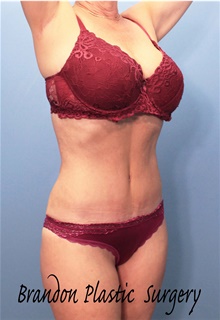 Tummy Tuck After Photo by Marvin Shienbaum, MD; Brandon, FL - Case 44749