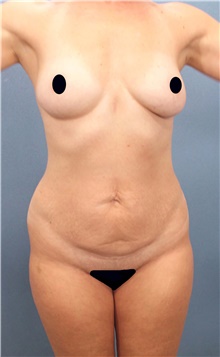 Tummy Tuck Before Photo by Marvin Shienbaum, MD; Brandon, FL - Case 44755