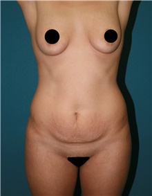 Tummy Tuck Before Photo by Marvin Shienbaum, MD; Brandon, FL - Case 44993