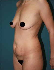 Tummy Tuck Before Photo by Marvin Shienbaum, MD; Brandon, FL - Case 44993