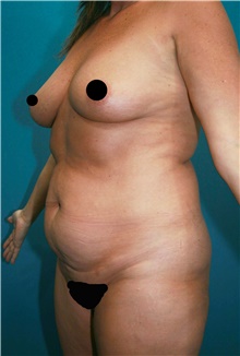 Tummy Tuck Before Photo by Marvin Shienbaum, MD; Brandon, FL - Case 44994