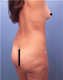 Buttock Lift with Augmentation Before Photo by Marvin Shienbaum, MD; Brandon, FL - Case 45208