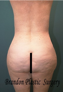 Buttock Lift with Augmentation After Photo by Marvin Shienbaum, MD; Brandon, FL - Case 45399