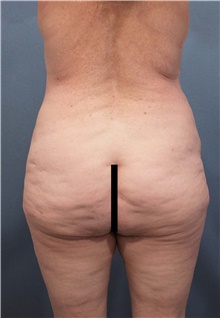 Buttock Lift with Augmentation Before Photo by Marvin Shienbaum, MD; Brandon, FL - Case 45399