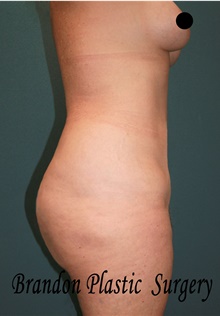 Liposuction After Photo by Marvin Shienbaum, MD; Brandon, FL - Case 45400