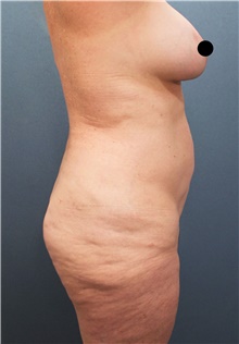 Liposuction Before Photo by Marvin Shienbaum, MD; Brandon, FL - Case 45400