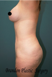 Liposuction After Photo by Marvin Shienbaum, MD; Brandon, FL - Case 45400