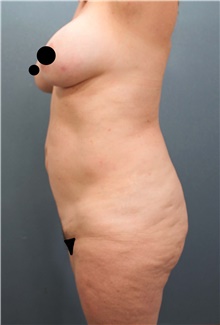 Liposuction Before Photo by Marvin Shienbaum, MD; Brandon, FL - Case 45400