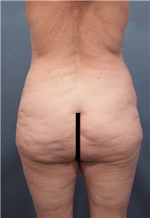 Liposuction Before Photo by Marvin Shienbaum, MD; Brandon, FL - Case 45400