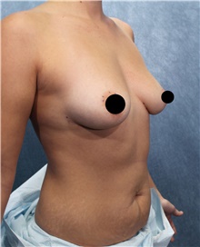 Breast Augmentation Before Photo by Marvin Shienbaum, MD; Brandon, FL - Case 45401