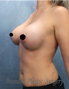 Breast Augmentation After Photo by Marvin Shienbaum, MD; Brandon, FL - Case 45401
