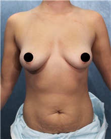 Breast Augmentation Before Photo by Marvin Shienbaum, MD; Brandon, FL - Case 45401
