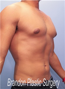 Liposuction After Photo by Marvin Shienbaum, MD; Brandon, FL - Case 45407