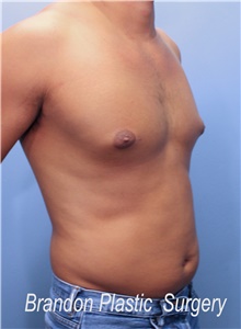 Liposuction Before Photo by Marvin Shienbaum, MD; Brandon, FL - Case 45407