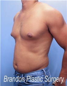 Liposuction Before Photo by Marvin Shienbaum, MD; Brandon, FL - Case 45407