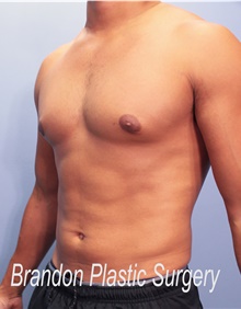 Liposuction After Photo by Marvin Shienbaum, MD; Brandon, FL - Case 45407