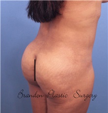 Buttock Lift with Augmentation After Photo by Marvin Shienbaum, MD; Brandon, FL - Case 45524