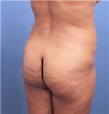 Buttock Lift with Augmentation Before Photo by Marvin Shienbaum, MD; Brandon, FL - Case 45524