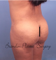 Buttock Lift with Augmentation After Photo by Marvin Shienbaum, MD; Brandon, FL - Case 45524