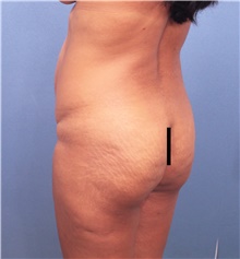 Buttock Lift with Augmentation Before Photo by Marvin Shienbaum, MD; Brandon, FL - Case 45524