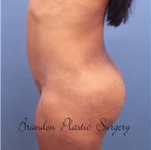 Buttock Lift with Augmentation After Photo by Marvin Shienbaum, MD; Brandon, FL - Case 45524