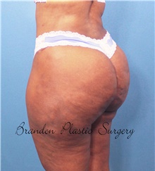 Buttock Lift with Augmentation After Photo by Marvin Shienbaum, MD; Brandon, FL - Case 45598