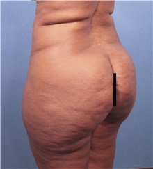 Buttock Lift with Augmentation Before Photo by Marvin Shienbaum, MD; Brandon, FL - Case 45598