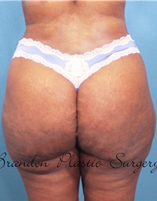 Buttock Lift with Augmentation After Photo by Marvin Shienbaum, MD; Brandon, FL - Case 45598