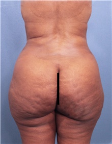 Buttock Lift with Augmentation Before Photo by Marvin Shienbaum, MD; Brandon, FL - Case 45598