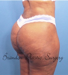 Buttock Lift with Augmentation After Photo by Marvin Shienbaum, MD; Brandon, FL - Case 45598