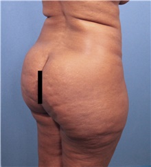 Buttock Lift with Augmentation Before Photo by Marvin Shienbaum, MD; Brandon, FL - Case 45598