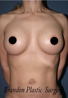 Breast Augmentation After Photo by Marvin Shienbaum, MD; Brandon, FL - Case 45599