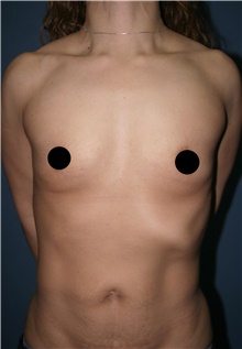 Breast Augmentation Before Photo by Marvin Shienbaum, MD; Brandon, FL - Case 45599