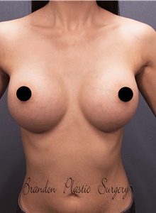 Breast Augmentation After Photo by Marvin Shienbaum, MD; Brandon, FL - Case 45657