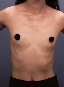 Breast Augmentation Before Photo by Marvin Shienbaum, MD; Brandon, FL - Case 45657